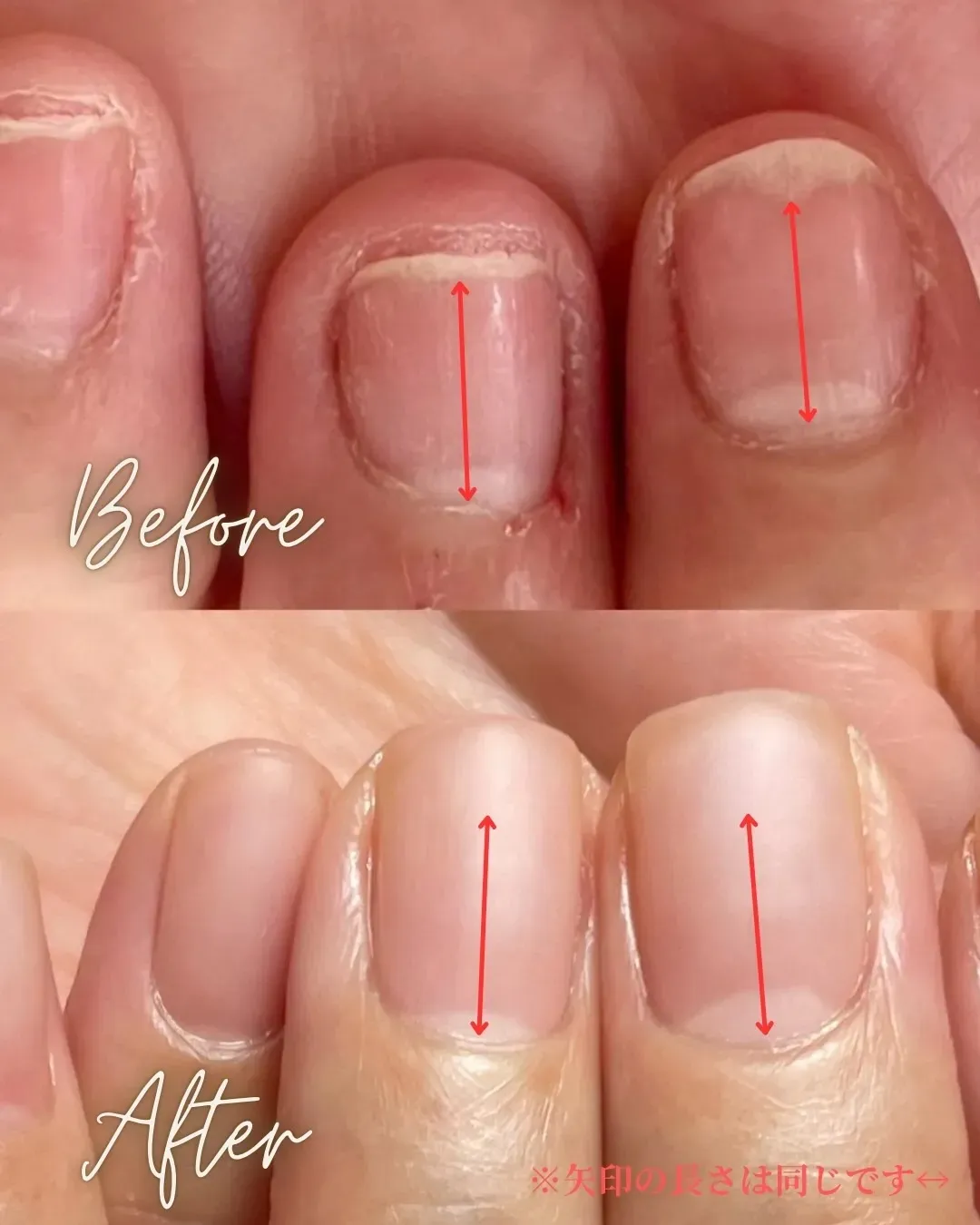 30代O様の施術事例（育成期間3ヶ月）